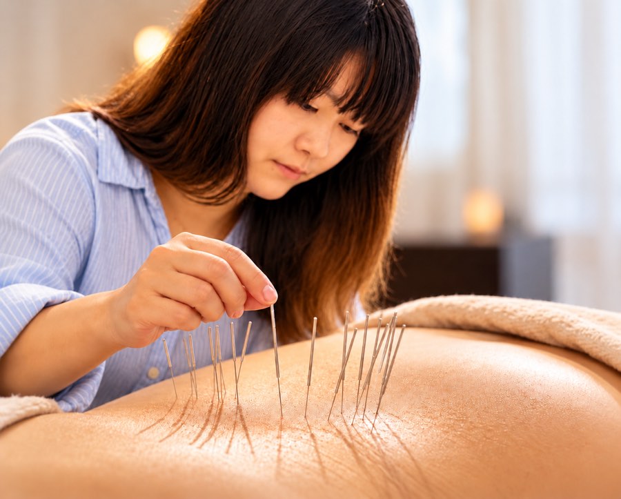 A practitioner placing fine acupuncture needles along a person's back