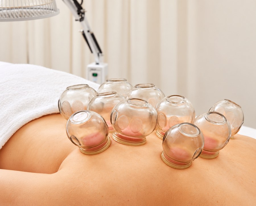 Glass cups set along a person's back under a heat lamp