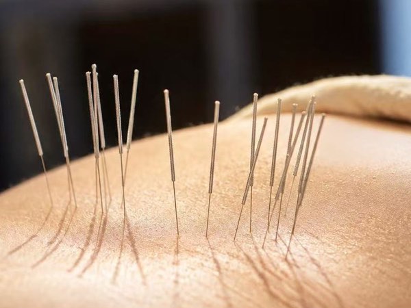 Acupuncture needles placed along a person's lower back