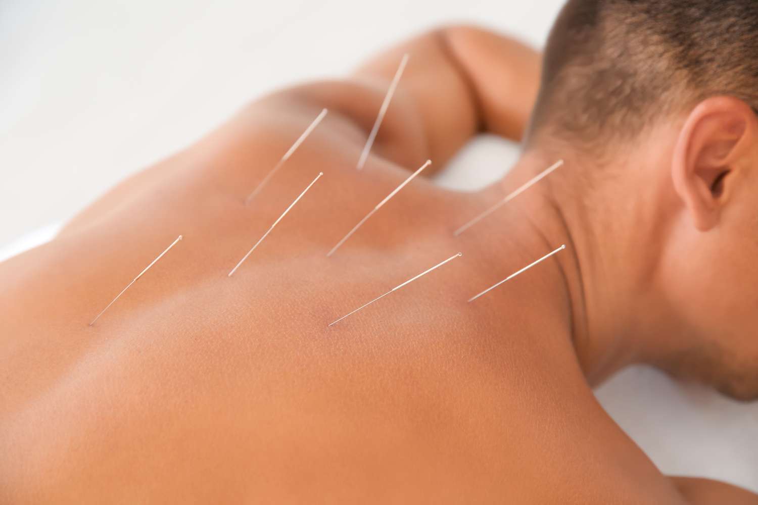 bigstock-Young-Man-Undergoing-Acupunctu-253275427-1500